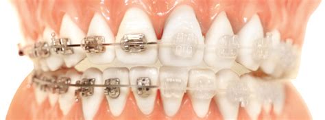 diferencia brackets metalicos y esteticos|brackets de cerámica.